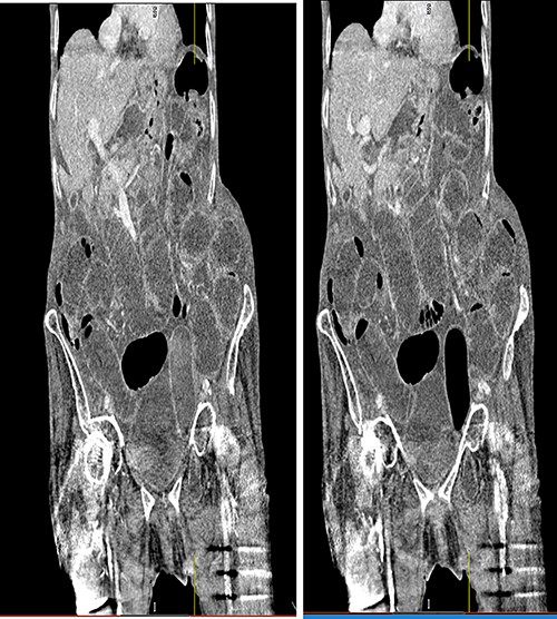Coronal view CT scan with IV contrast showing dilated small bowel loops and bowel loop through the left obturator canal.