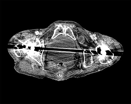 Axial view of CT scan showing the bowel loop through the left obturator hernia.