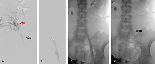 Angiographic images during percutaneous angioplasty of the left CIV. (A) Black arrow demonstrates left CIV stenosis secondary to anatomic compression with extensive clots. Red arrow demonstrates the collateral venous circulation, indicating chronicity of MTS. (B) Balloon angioplasty of the left CIV. (C) Left CIV patent post angioplasty. (D) Arrow demonstrates 16 × 60 mm stent deployed across the left CIV.