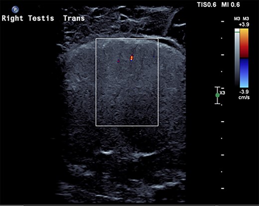 US scrotum showing lack of arterial blood flow to right testicle.
