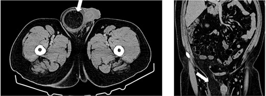 Computed tomography (CT) axial and coronal imaging showing large fat-containing right inguinal hernia (white arrow).