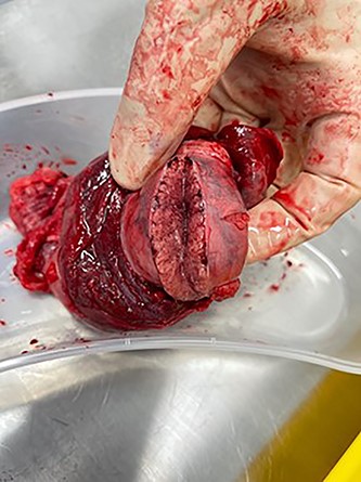 Ischemic, infarcted testicle showing lack of blood flow.