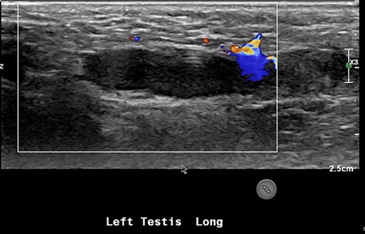 US showing lack of arterial flow into the left testicle.