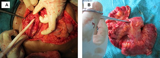 Multiple ileal perforations (A) Intraoperative—largest perforation pointed (B) Resected specimen.