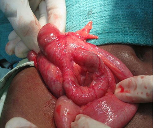 Acute retrocaecal appendicitis.