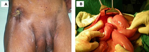 Enterocutaneous fistula (A) pre-operative (B) intra-operative-Ileocaecal mass adherent to the abdominal wall.