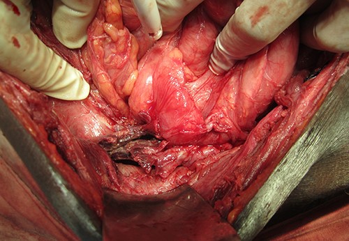 Distal ileal gangrene causing obstruction—gangrenous ileal loop adherent to the caecum and lateral abdominal wall.
