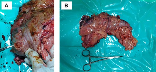 Colonic malignancy (A) malignant caecal ulcer (B) resected specimen.