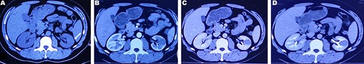 CT plain scan and enhanced scan of mucus-poor MTSCC. (A) CT scan showed a low-density mass in the lower pole of the left kidney (arrow), unclear boundary, swelling growth in kidney; (B) enhanced CT scan of corticomedullary phase shows tumor mild homogeneous enhancement, (C) nephrography phase, (D) renal excretion phase.