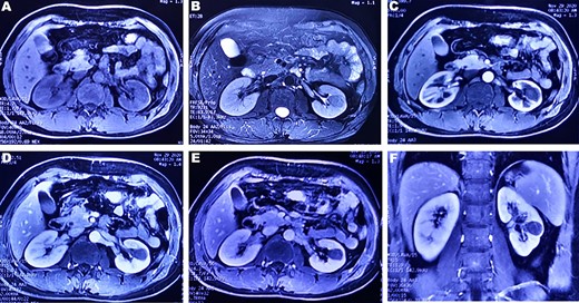 (A and B) A round-like abnormal signal can be seen in the cortex and medulla of the left kidney, which is equal signal on T1WI and slightly low signal on T2WI; (C–E) In the arterial phase, parenchymal phase and venous phase of enhanced MRI, a heterogeneous, progressive and slow enhancement is noted. (F) Enhanced arterial phase of coronary T1WI showed a low signal mass located in the lower pole of the left kidney.