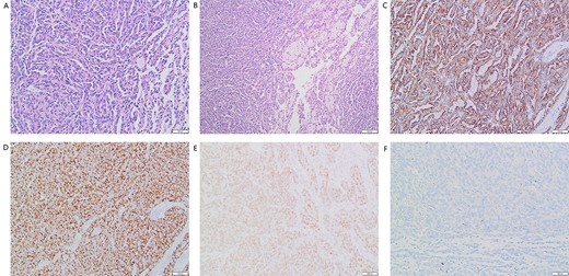 (A) Many elongated tubular epithelial cells arranged in a small amount of mucus. Some spindle cells can be seen (magnification, ×20); (B) Obvious foamy macrophage aggregates in some areas (magnification, ×10). Immunohistochemical results: (C) CK7(+), (D)P504S (+), (E)Pax-8(+), (F)CD10(−).