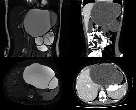 MRI (left) and CT (right) preoperative imaging.