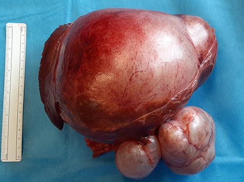 Resected left hepatectomy specimen showing the large, multiloculated cystic lesion arising from the left lobe of the liver.