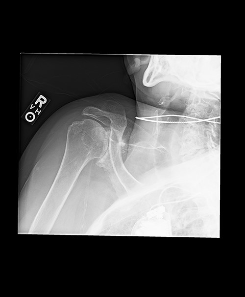 Grashey view demonstrating glenohumeral osteoarthritis with acromiohumeral space narrowing and superior humeral head migration.
