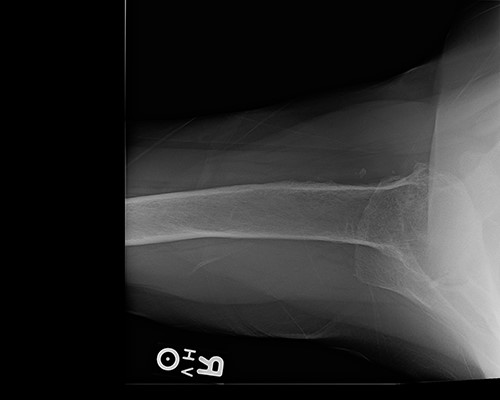 Axillary view demonstrating glenohumeral osteoarthritis.