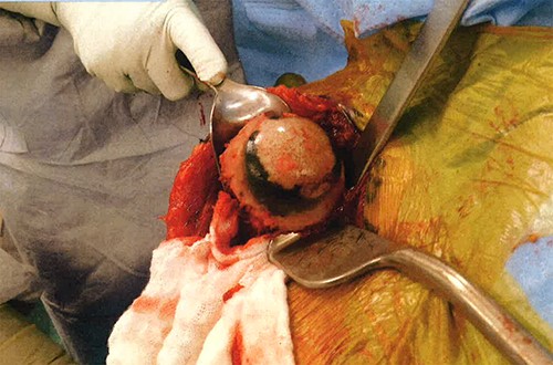 Annular ochronotic pigmentation of right humeral head articular surface.