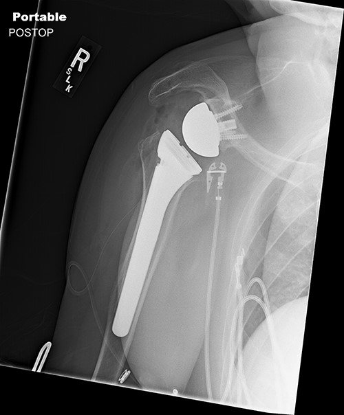 Postoperative Grashey view.
