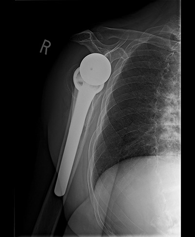 Postoperative Scapular-Y view.