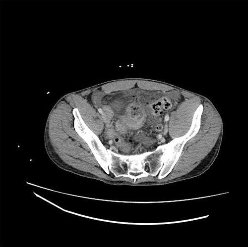 CT demonstrating thickened loop of ileum in the pelvis with pneumoperitoneum and free fluid.