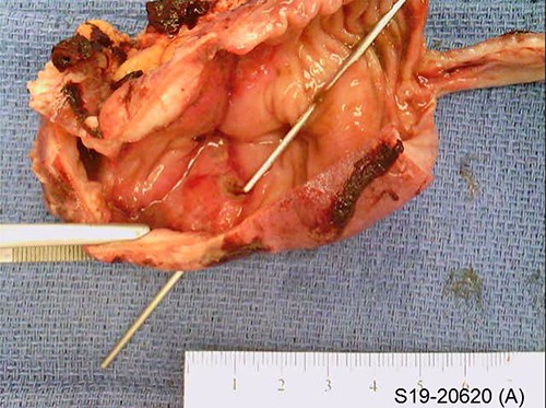 Gross pathology specimen with probe depicting area of perforation.