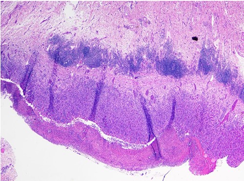 Histologic evaluation of specimen showing ulcerated small bowel wall with transmural and subserosal acute inflammatory changes.