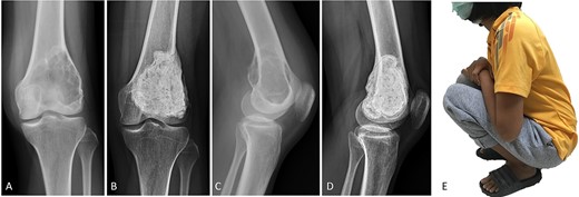 (A, C) Case no. 5: female, 23 years of age with GCTB at the distal femur without subchondral bone involvement, Campanacci grade III. (B, D) Radiograph at 81 months after extended curettage with hydrogen peroxide, phenol and cementation. (E) MSTS score 93%.