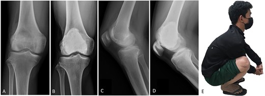 (A, C) Case no. 6: male, 15 years of age with GCTB at the distal femur without subchondral bone involvement, Campanacci grade II. (B, D) Radiograph at 67 months after extended curettage with hydrogen peroxide, phenol, and cementation. (E) MSTS score 100%.