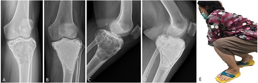 (A, C) Case no. 7: female, 54 years of age with GCTB at the proximal tibia with subchondral bone involvement, Campanacci grade III. (B, D) Radiograph at 58 months after extended curettage with hydrogen peroxide, phenol, and cementation. (E) MSTS score 86%.