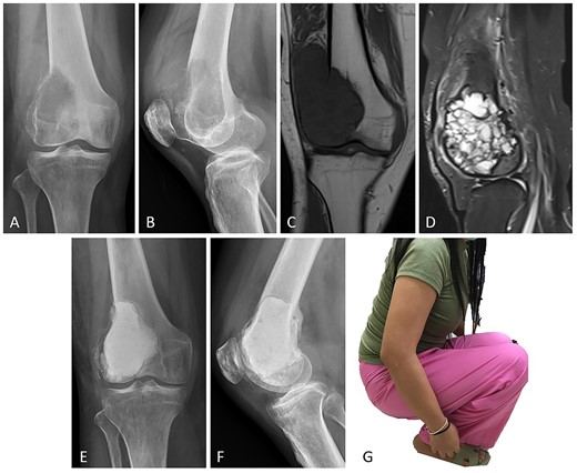 Case no. 13: (A–B) male, 32 years of age with GCTB at the distal femur with subchondral bone involvement, Campanacci grade III. (C–D) Preoperative T1-weighted coronal view MRI showing low-intensity with soft tissue extension and T2-weighted sagittal view MRI showing a heterogeneous high-intensity change with surrounding soft-tissue edema. (E–F) Radiograph at 26 months after extended curettage with hydrogen peroxide, argon beam coagulation, and cementation with hydroxyapatite bone substitution (packed above the subchondral bone). (G) MSTS score 86%.