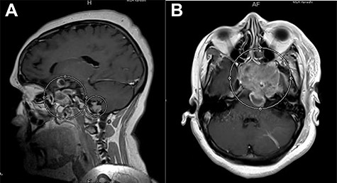 (A) Post-contrast T1-weighted MRI, sagittal section, showing a heterogeneously enhancing lesion in the right sellar region, with supra-sellar extension, and clivus involvement. (B) Post-contrast T1-weighted MRI, axial section, showing re-demonstration of abnormally enhancing lesion with superior cystic component just above the foramen magnum on the right side of the midline.