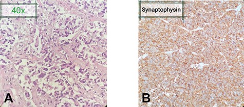(A) Fragments of the lesion arranged in the form of nests and papillary architecture with tumor cells arranged around fibrovascular cores. The tumor cells are monomorphic, have moderate amount of cytoplasm and nuclei showing stippling of chromatin. (B) Tumor cells highlighted on immunehistochemical stain Synaptophysin. No significant nuclear atypia or mitoses are appreciated.
