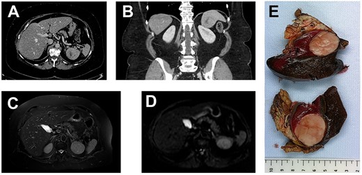 (A, axial) and (B, coronal), portal venous phase CT-scan showing a 43×40×39 mm lesion of the inferior pole of the spleen. The lesion is heterogeneous with a center of necrotic appearance, without calcification and enhancement after injection of the contrast product.