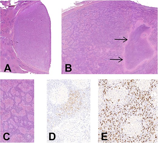 (A) Histology of EBV+ inflammatory FDC sarcoma. Low magnification showing the well delimitation of the tumor (at right) from the splenic parenchyma (at left), H&E, ×7. (B) The granulomatous appearance is well-noticed with a large area of necrosis (arrows), H&E, ×14. (C) There is an abundant lymphoplasmacytic infiltrate between the noncaseating epithelioid granulomas, H&E, ×90. (D) CD21 highlights the neoplastic FDCs situated in the intergranulomatous areas, CD21 immunohistochemistry, ×200. (E) Corresponding image of D showing an intense positivity of neoplastic cells for EBV, EBER hybridization, ×200 (E).