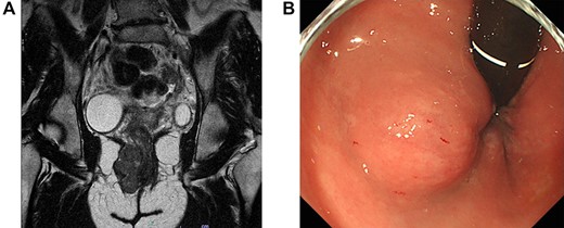 (A) Magnetic resonance imaging of the pelvis (sagittal section) demonstrates a 4.6 × 2.8-cm tumor in the right perineal area. (B) Proctoscopy reveals a submucosal tumor near the right wall of the anal canal.