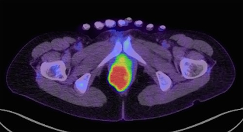 FDG-PET/CT (transverse section) show FDG accumulation in a mass with maximum standardized uptake of 17.9.