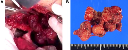 (A) Extracapsular dissection was performed and sphincter fibers were repaired with absorbable thread. (B) A gray–white bifurcated nodular tumor of size 4.6 × 3.5 × 2.7 cm was excised.