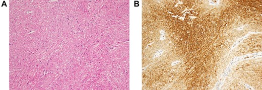 (A) Histopathological examination reveals fenestrated growth of poorly dysmorphic short spindle-shaped cells. (B) Immunohistochemical staining shows that the tumor cells are positive for GLUT-1.