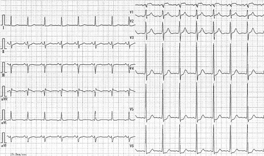ECG indicated normal sinus rhythm without abnormal Q wave.