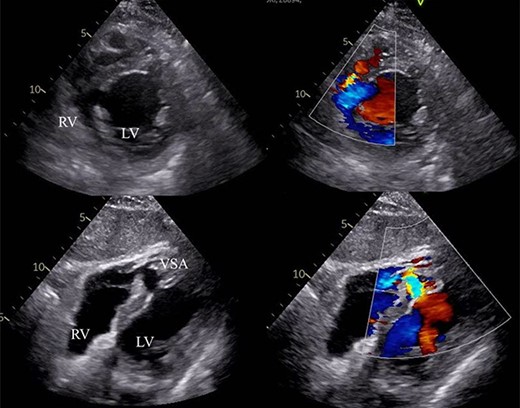 VSA with LR shunt flow. RV: right ventricle, LV: left ventricle, VSA: ventricular septal aneurysm.