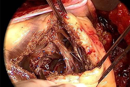 VSA at the center of ventricular septum (blue dot circle) with VSP to the RV cavity (white arrow) in the operative finding. VSA: ventricular septal aneurysm, VSP: ventricular septal perforation, RV: right ventricle.