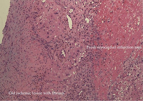 Histopathologic image of VSA wall showed old myocardial ischemic lesion with fibrosis and flesh myocardial infarction area (Hematoxylin and Eosin stain: ×200).