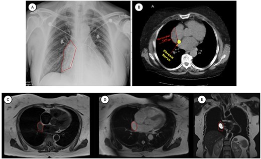 Representative images of pericardial cysts on commonly employed imaging modalities. (A) The chest X-ray imaging of the patient described in the case report AP CXR showing widened mediastinum in a patient with a wide differential diagnosis which ultimately was found to be pericardial cyst. (B) CT imaging of the patient described in the case report with representative images of our patient demonstrating a sizeable pericardial cyst marked with red arrows and its close association with right phrenic nerve marked in gold. (C–E) MRI T1 (C) and T2 (D–E) appearances of pericardial cysts. Representative images of pericardial cyst appearance on gadolinium-enhanced MRI sequences. *Figure edited with BioRender.