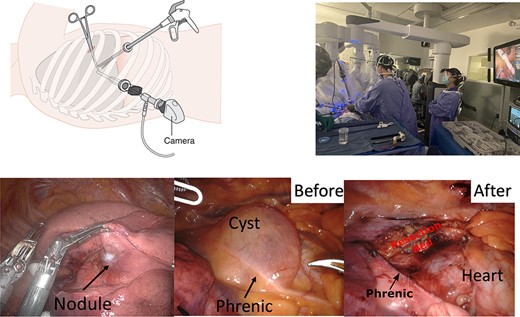 Top row: intra-operative patient positioning, instrument placement and robotic device deployment for minimally invasive thoracoscopic resections. CC4.0: CRUK Wikimedia commons bottom row: left column: mobilization of the right upper lobe with visualization of a SPN noted on preoperative cross-sectional imaging. Middle column: visualization of the pericardial cyst which demonstrates very close relationship and compression of the right phrenic nerve. Right column: the pericardial cyst was removed and resection showing preservation of the nerve.