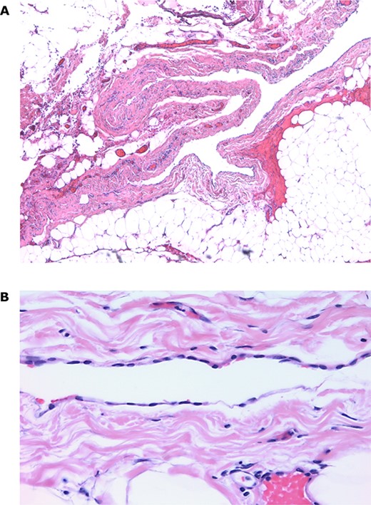 Histopathologic analysis of the pericardial cyst. (A) Pericardial cyst lining demonstrating fibrous wall surrounded by pericardial fat and blood vessels (×5 image); (B) Simple pericardial cyst lining surrounded by fibrous wall (×40 image).