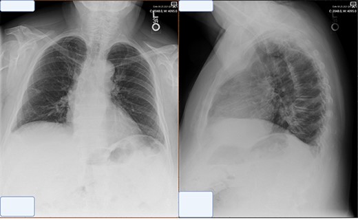 Post-operative chest X-ray obtained at 2 week follow-up showing trace pleural effusion and otherwise normal X-ray.