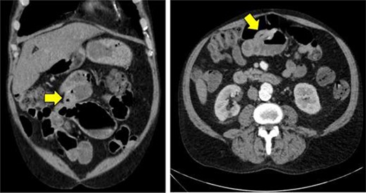 Computed tomography imaging of the abdomen and pelvis showing mild thickening of the wall of the proximal ileum.