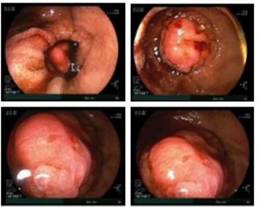 Double balloon enteroscopy revealing a 3 cm mass located in the distal jejunum/proximal ileum.