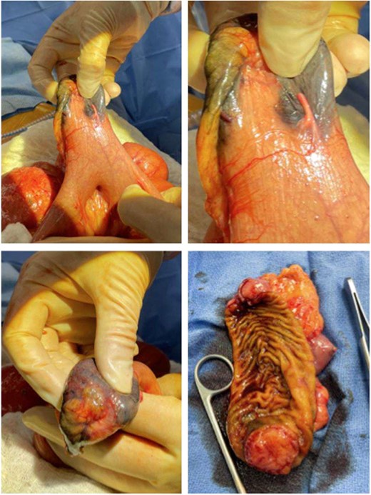 Gross pathology images of the bowel mass located within a Meckel’s diverticulum.