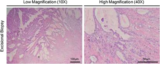 Hematoxylin and eosin staining of the resected specimen showing a moderately to poorly differentiated adenocarcinoma.