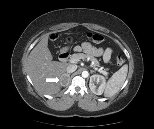 Axial CT of the abdomen showing the right adrenal mass in Patient 1 (white arrow).